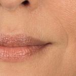 Dermal Fillers Clinical Results