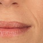 Dermal Fillers Clinical Results